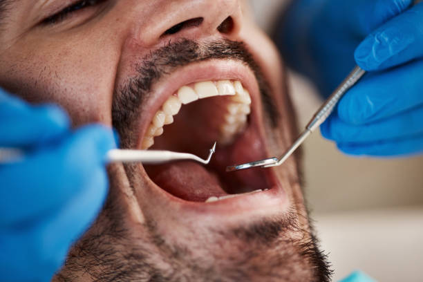 Best Emergency Wisdom Teeth Removal in Osceola, WI